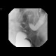 Carcinoma of sigmoid colon, barium enema: RF - Fluoroscopy